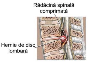 Hernia de disc: Simptomele pe care nu trebuie să le ignori și metode moderne de tratament
